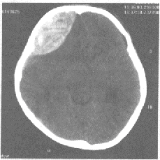 男，40岁，头部摔伤2小时，头部CT平扫结果如下图，应诊断为（）