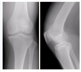 患者女，54岁，右膝关节痛。实验室检查：类风湿因子阳性，除外膝关节类风湿性关节炎。x线检查结果如下图