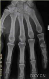 患者男，28岁，偶尔发现右手第5近节指骨肿胀。查体：右手掌肿块，质硬，无明显压痛，无发热。进行了右手