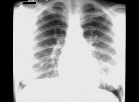 男，12岁，体检时发现心脏有杂音。在胸骨左缘第二肋间闻及Ⅱ～Ⅲ级收缩期喷射性杂音，未扪及震颤，P亢进