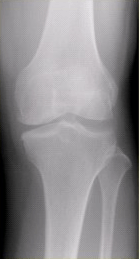 患者女，54岁，右膝关节痛。实验室检查：类风湿因子阳性，除外膝关节类风湿性关节炎。X线检查结果如下图