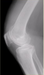 患者女，54岁，右膝关节痛。实验室检查：类风湿因子阳性，除外膝关节类风湿性关节炎。X线检查结果如下图