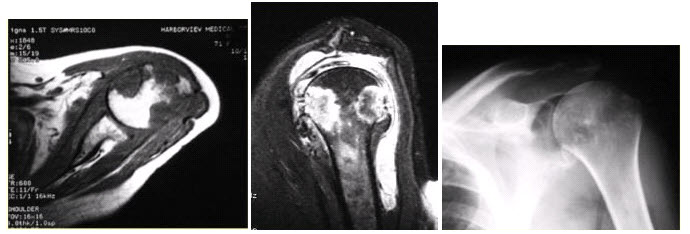 患者女，71岁，双侧肩痛半年余。有较长sle病史和激素用药史。行左肩x线平片、mr检查（下图）。患者