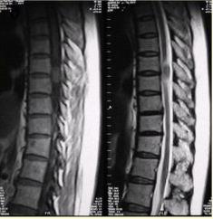 患者女，52岁，颈部不适2年。MRI检查结果如下图。观察所给出的MRI影像，对病变定位、定性诊断有意