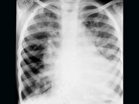 患儿男，4岁，生后反复发生呼吸道感染，发育差，活动后气促，无发绀。听诊胸骨左缘第3肋间可闻及Ⅲ级粗糙
