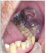 男性患者，50岁，发现口内粘膜黑色肿物两年，近期生长迅速，且破溃，出血，伴疼痛，有颌下淋巴肿大。如图