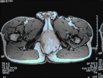 患者男，18岁，会阴肿块，影像学表现如图所示。诊断可能是（）。