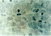 如该图所示的急性白血病幼稚细胞髓过氧化物酶和非特异性酯酶均呈阳性，可诊断为（）	A. 急性粒细胞白血