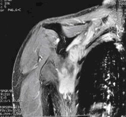 患者女，43岁，因“左胸壁肿块”来诊。行穿刺活检，镜下形态如图所示。该病涉及的信号传递通道是（）。