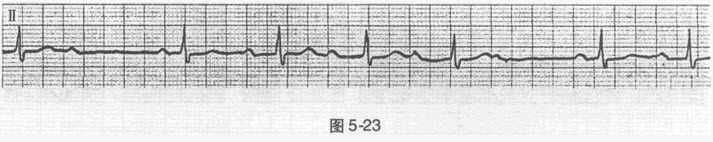 患者女性，26岁，偶发胸闷、心悸。心电图如图5-23所示，应诊断为（）。