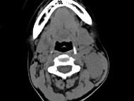 女，19岁，发现左颈部无痛性肿块2年余，可活动，CT如图所示，最可能诊断为（）