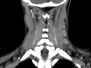 女，19岁，发现左颈部无痛性肿块2年余，可活动，CT如图所示，最可能诊断为（）