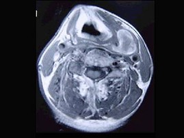 男性，40岁，发现左侧颈部小包块，CT、MRI检查如图所示，请选择最可能的诊断（）