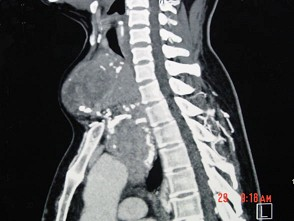 女性，48岁，颈部包块3年，近来胸闷、憋气、胸痛，CT扫描如图，请选择正确的描述和答案（）