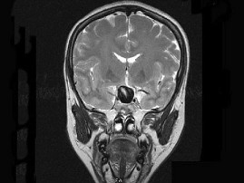 女，43岁，反复头痛10个月，CT检查如图，最可能诊断为（）？