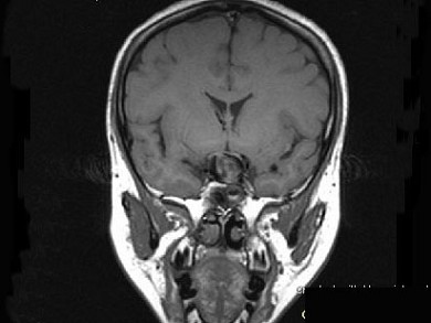 女，43岁，反复头痛10个月，CT检查如图，最可能诊断为（）？