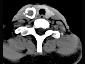 50岁女性患者，体检发现右侧甲状腺有较硬结节，CT扫描如图所示，请选择正确的描述和答案（）