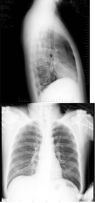 男性，38岁，突感胸部不适，X线检查如图，最可能的诊断是()