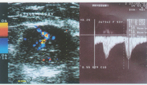 超声综合描述：左乳外上象限可见类圆形低回声区，边缘欠规整，内回声不均，CDFI：内可见丰富血流信号，