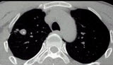 男性，25岁，低热、咳嗽2个月。胸部CT见图，最可能的诊断是()