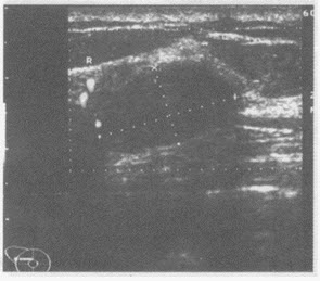 临床物理检查：右乳腺可扪及一肿物，活动度好，边缘羌滑。超声综合描述：右乳外上象限可见1．9cm×1．