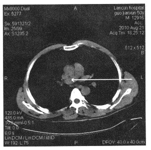 下面胸部断层图像中箭头所指为（）