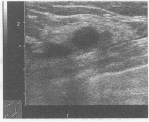 超声综合描述：双侧乳腺腺体层结构紊乱，内可见多个类圆形无回声区，边界整齐光滑，包膜完整，最大位于左乳