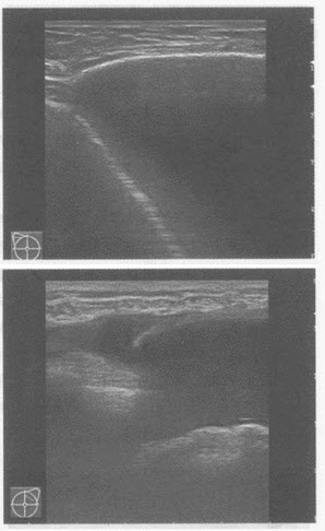 超声综合描述：双侧乳腺可见无回声假体，右侧乳腺内假体形态规则，边界清晰，其周围未见异常回声区；左侧乳