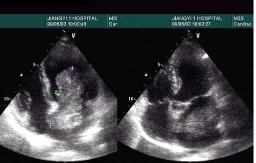 根据心尖四腔心切面声像图所示，超声诊断为（）