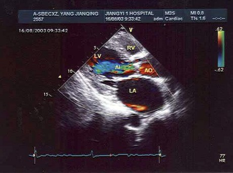 某患者左室长轴切面超声心动图如图所示，诊断为（）。