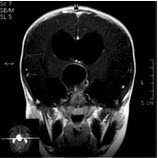 入院检查头部MRI，如图所示，诊断有可能是？（）