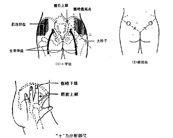 肌内注射连线法定位图片