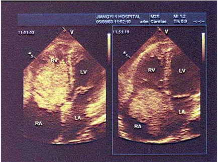 根据心尖四腔切面声像图所示，超声诊断为（）。