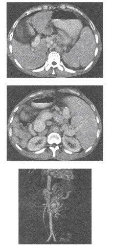 男，38岁。CT增强扫描示肝脏体积缩小，肝表面欠光整；肝裂增宽，肝叶比例失调，尾叶较大。肝实质密度不
