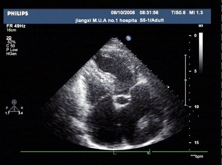 某患者，超声心动图检查如图，考虑（）。