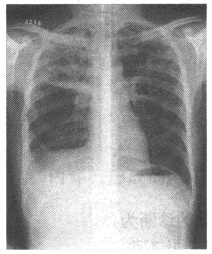男，28岁，轻咳2个月，有盗汗。胸片如图此病属下列哪型（）