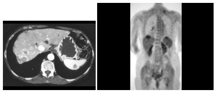 子宫内膜癌患者，CT及PET如图所示，最可能的诊断为（）