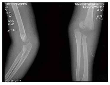 女，1岁10个月，右肘部外伤，如图所示，最佳的诊断为（）