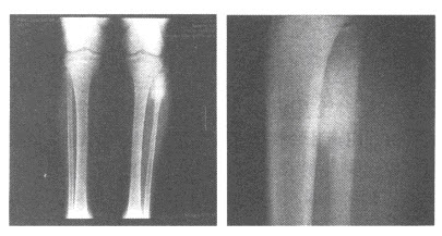 男，16岁，左小腿上端疼痛3个月余，局部肿胀，皮温稍高。结合左胫腓骨正侧位片，最可能的诊断为（）