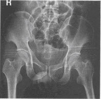  该患者骨盆骨折按Tile分型，应（）。