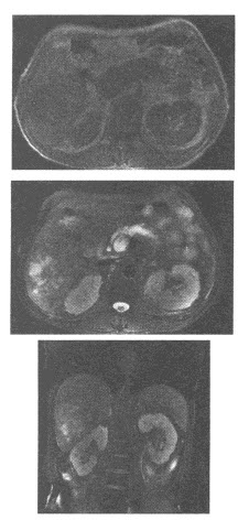 男，64岁。1个月来发热，上腹疼痛，MRI扫描如下图，显示肝右叶巨大类圆形异常信号，大小约6.4cm