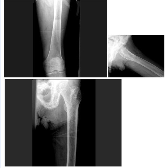 男，60岁，左股骨痛1年余，结合图像，最可能的诊断是（）