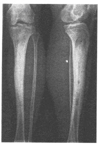 患者，男性，39岁，左小腿肿胀、疼痛1个月余，夜间加重。左胫腓骨正侧位片如下，最可能的诊断为（）