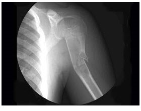 男，5岁，外伤后致左肩关节疼痛伴关节活动障碍1小时，X线检查如图所示，最可能的诊断是（）