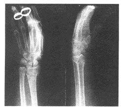 女，41岁，2小时前跌倒后手掌着地，右腕部肿痛。根据右腕关节正侧位片，应诊断为（）