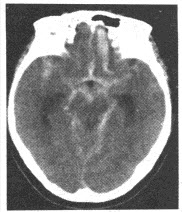 女性，60岁，意识不清1小时，血压：118/88mmHg，颅脑CT如下图，最可能的诊断为（）