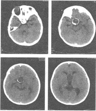 患儿，男，5岁，CT平扫图像如下，最可能的诊断是（）