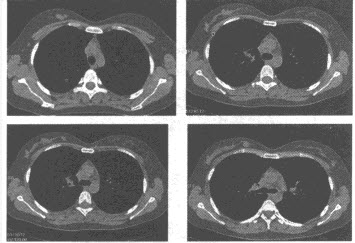 女，26岁，胸部CT扫描见右侧乳腺多发结节状软组织密度影，图像如下，最可能的诊断为（）