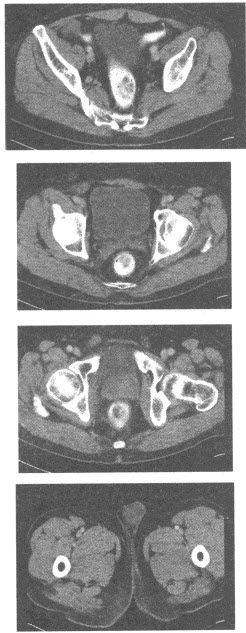 男，20岁，右侧阴囊空虚，触诊时阴囊内无睾丸，根据所提供的增强CT图像：关于该疾病的诊断，首选的影像