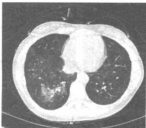 女，39岁，发热、咳嗽1周，WBC：15×109/L，胸部CT平扫如图同一病例上部层面如图，合理的解